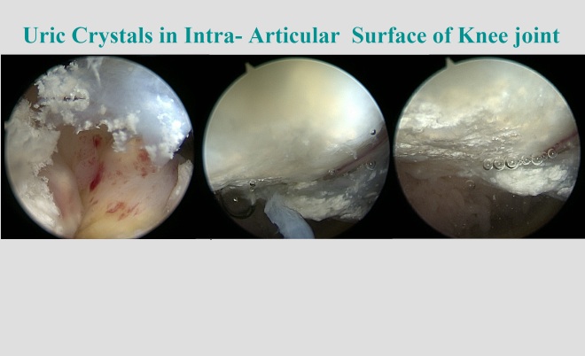 Uric Acid Crystals in Knee Joint