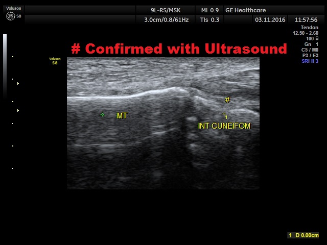 confirmed-with-ultrasound-unclear-on-plain-x-ray
