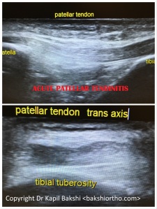 Acute Patellar Tendinitis