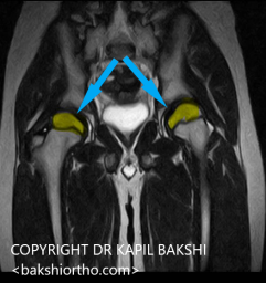 MRI Scan shows bilateral involvement